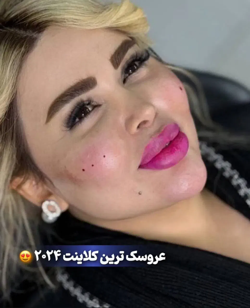 تزریق ژل بوتاکس توسط پزشک|خدمات آرایشگری و زیبایی|کرمانشاه, |دیوار