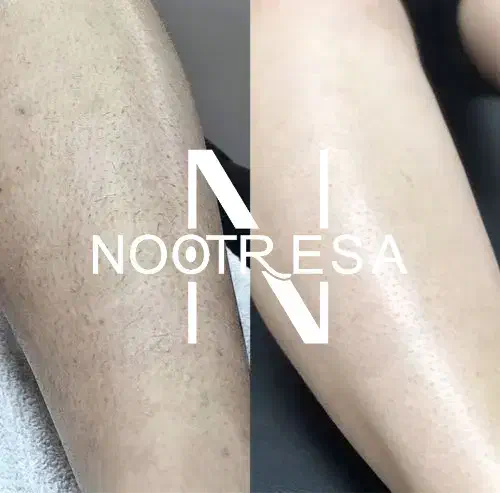 لیزر موهای زائد مرکز لیزر مو در میدان انقلاب تهران|خدمات آرایشگری و زیبایی|تهران, فلسطین (میدان انقلاب)|دیوار