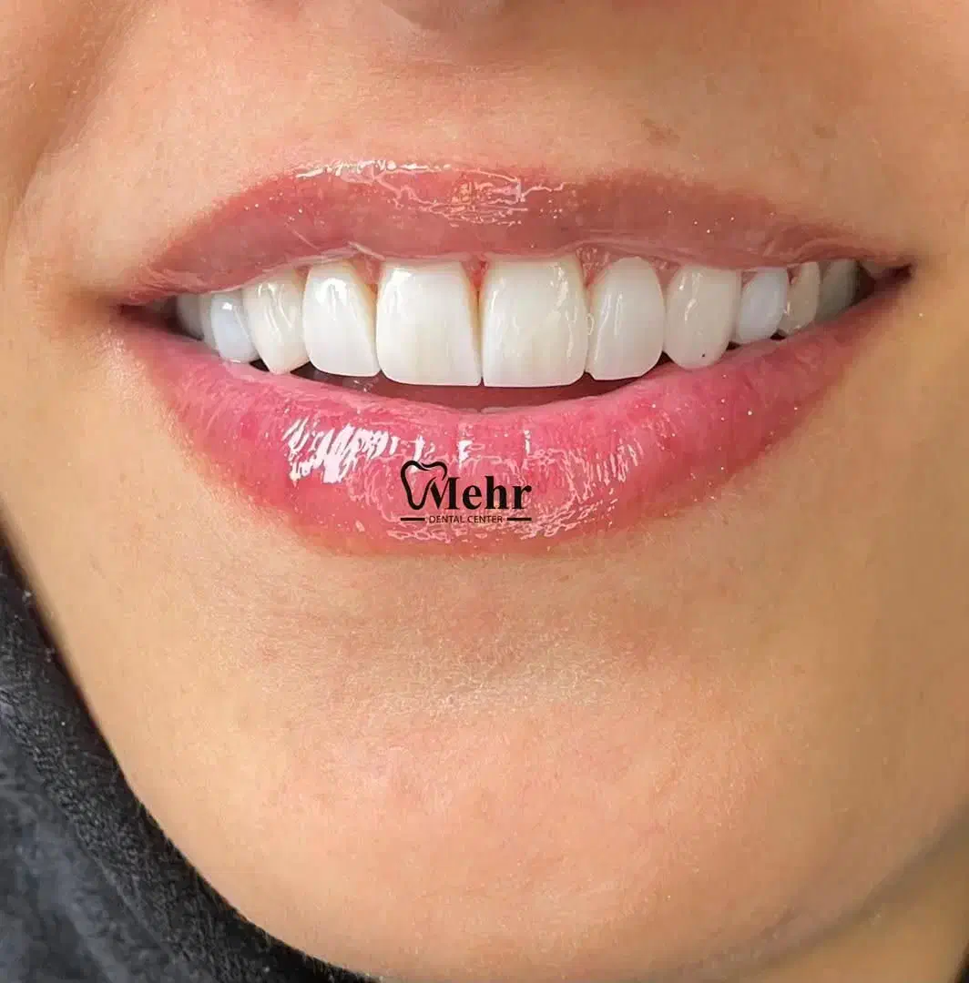 کامپوزیت هشت واحد فقط با ۵ تومان|خدمات آرایشگری و زیبایی|تهران, هفت حوض|دیوار