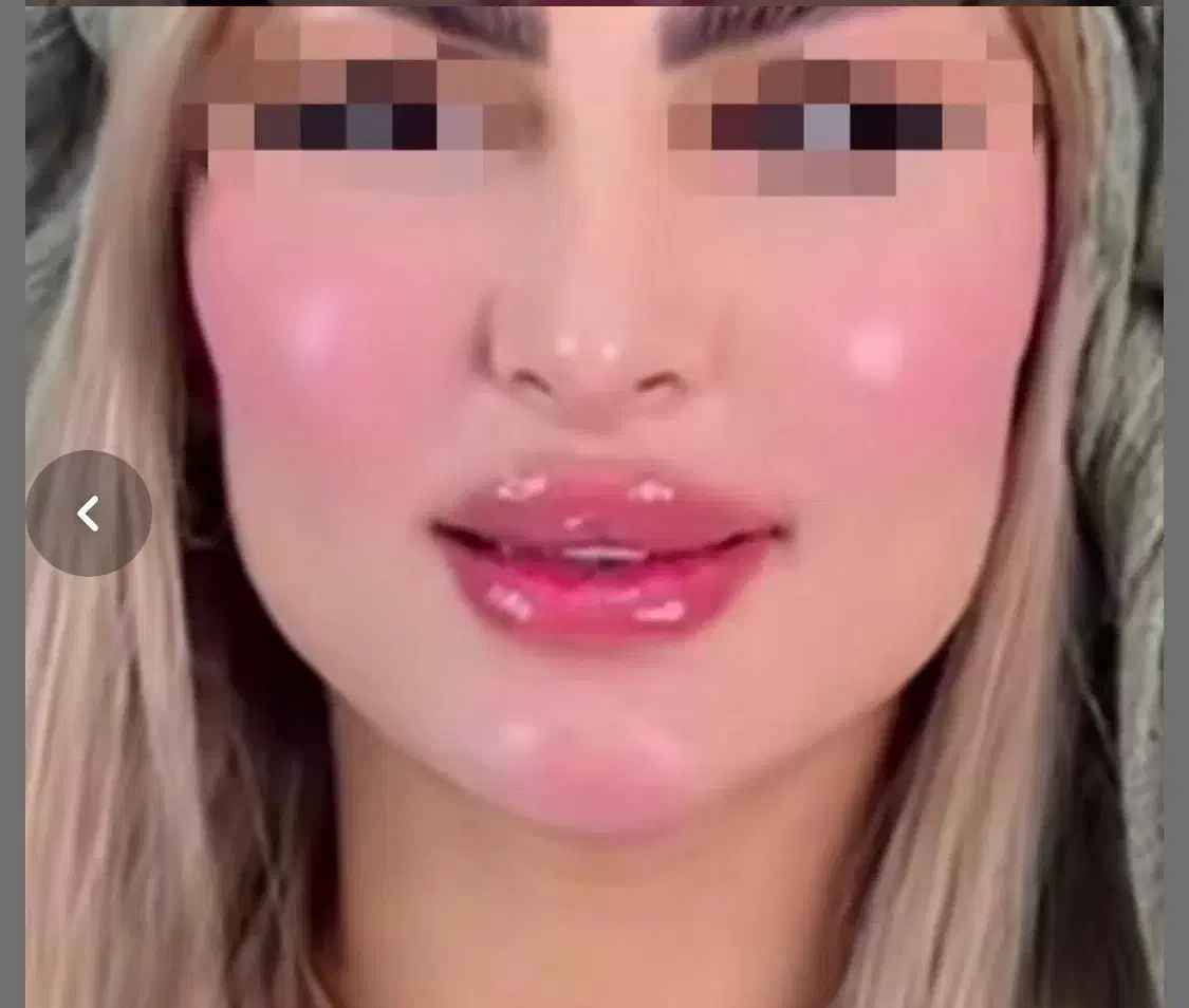 تزریق چربی ،ساکشن غبغب،پی ارپی مو ،مزو زگیل میخچه|خدمات آرایشگری و زیبایی|یاسوج, |دیوار