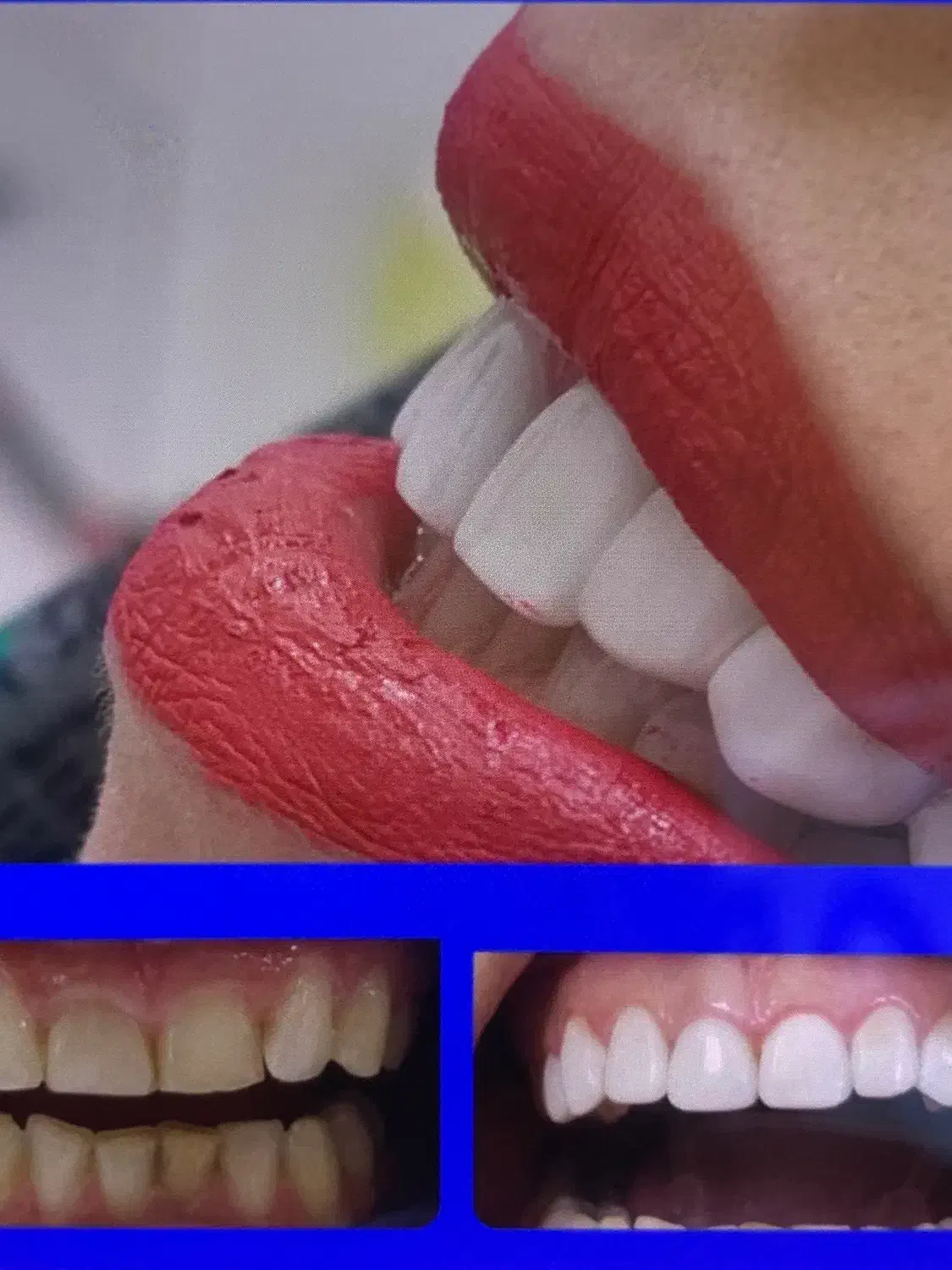 ایمپلنت ارتودنسی لمینت کامپوزیت|خدمات آرایشگری و زیبایی|مشهد, دوست آباد|دیوار