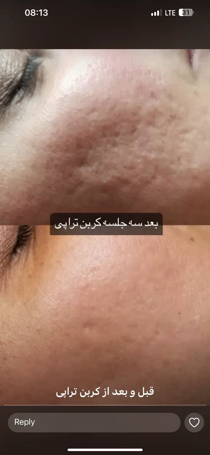 لیزر تتو وروشن کننده بدن|خدمات آرایشگری و زیبایی|پاکدشت, پاکدشت (مامازند)|دیوار