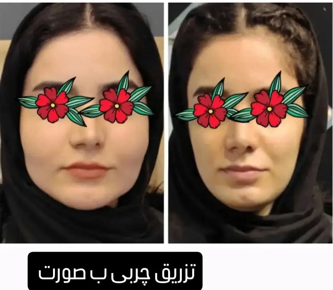 لیپولیز|خدمات آرایشگری و زیبایی|دورود, |دیوار