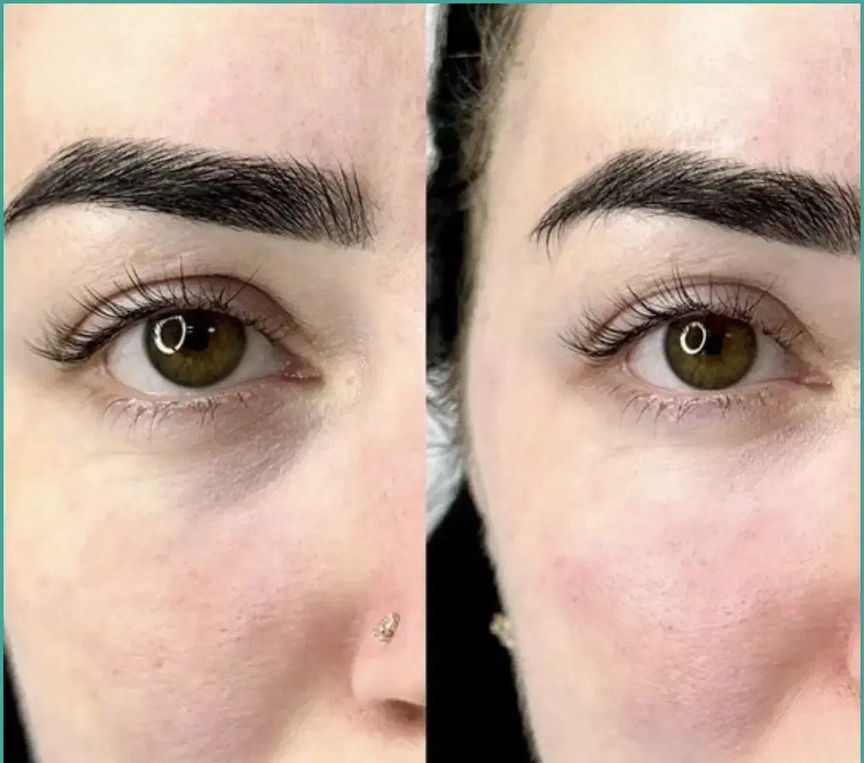 تخفیف ویژه تزریق فیلر|خدمات آرایشگری و زیبایی|اندیشه, اندیشه فاز ۱|دیوار