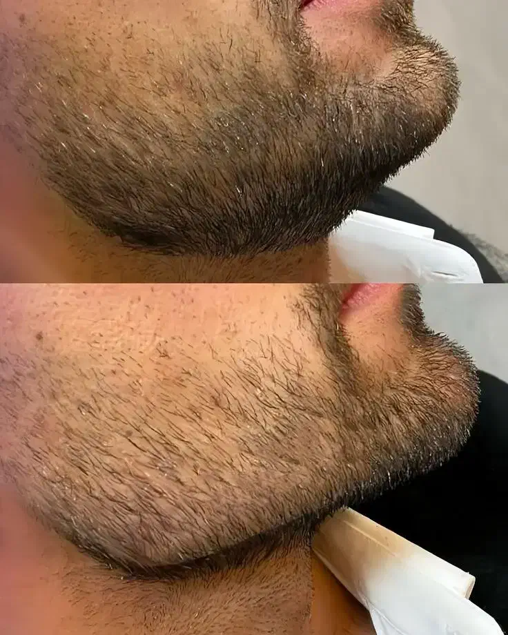 جشنواره ویژه کاشت ابرو ،بوتاکس، فیلر ..|خدمات آرایشگری و زیبایی|بوشهر, |دیوار