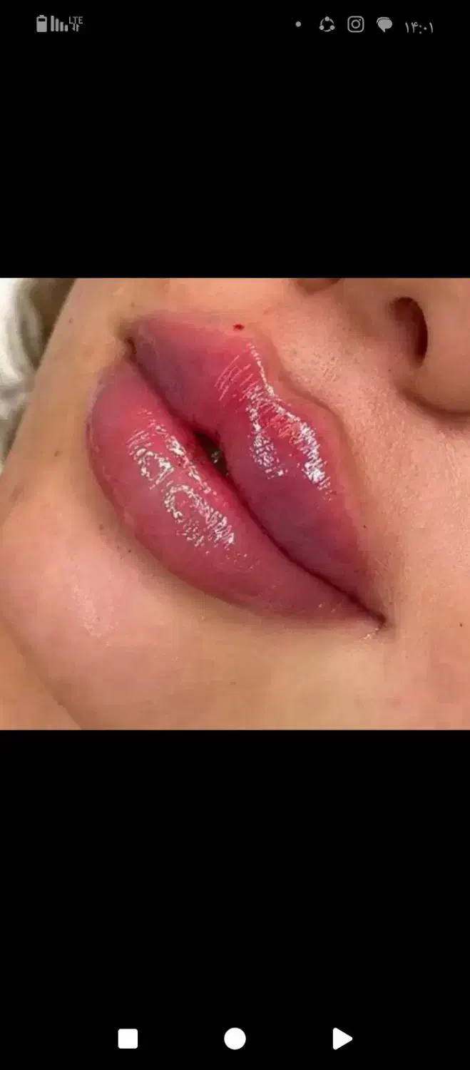 آموزش و تزریق ژل و بوتاکس|خدمات آرایشگری و زیبایی|اسلامشهر, شهرک سالور|دیوار