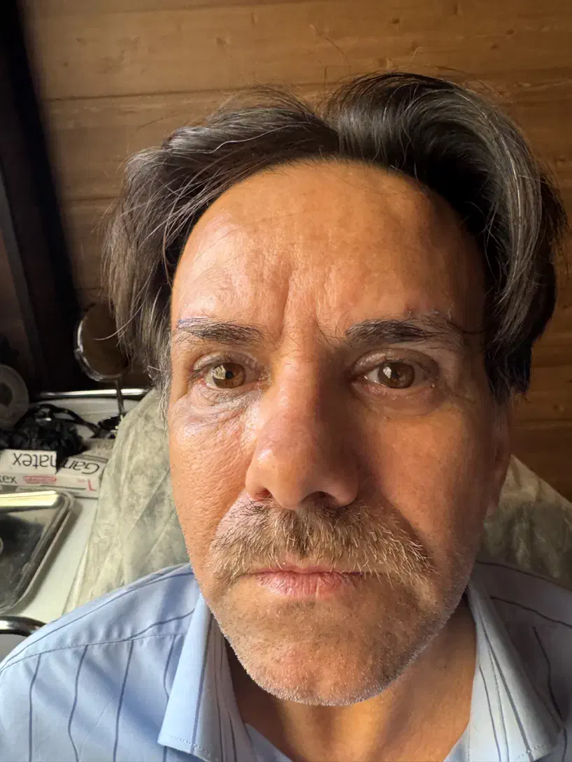 لیفت شقیقه توسط متخصص چشم تخفیف ویژه سه نفر اول|خدمات آرایشگری و زیبایی|تهران, تجریش|دیوار