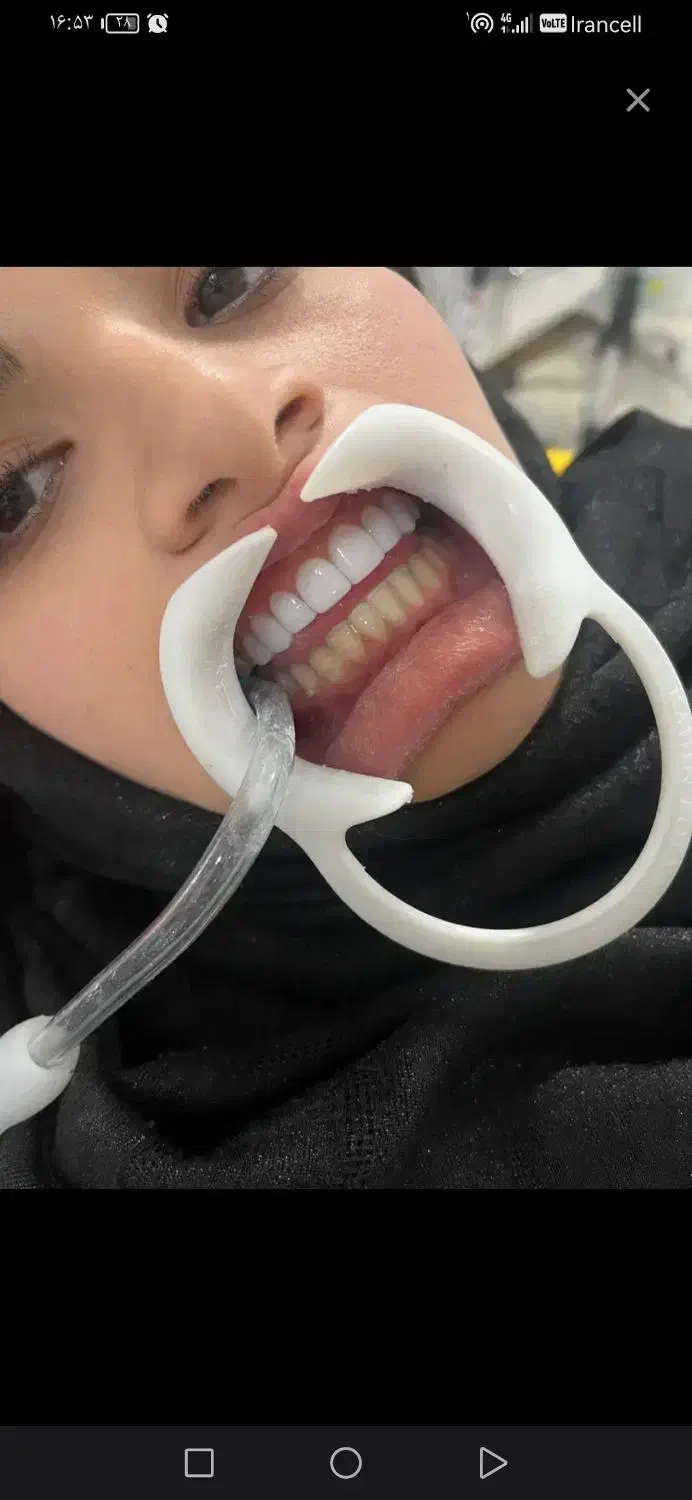 کامپوزیت دندان هر فک 5تومن|خدمات آرایشگری و زیبایی|محمدشهر, محمدشهر|دیوار