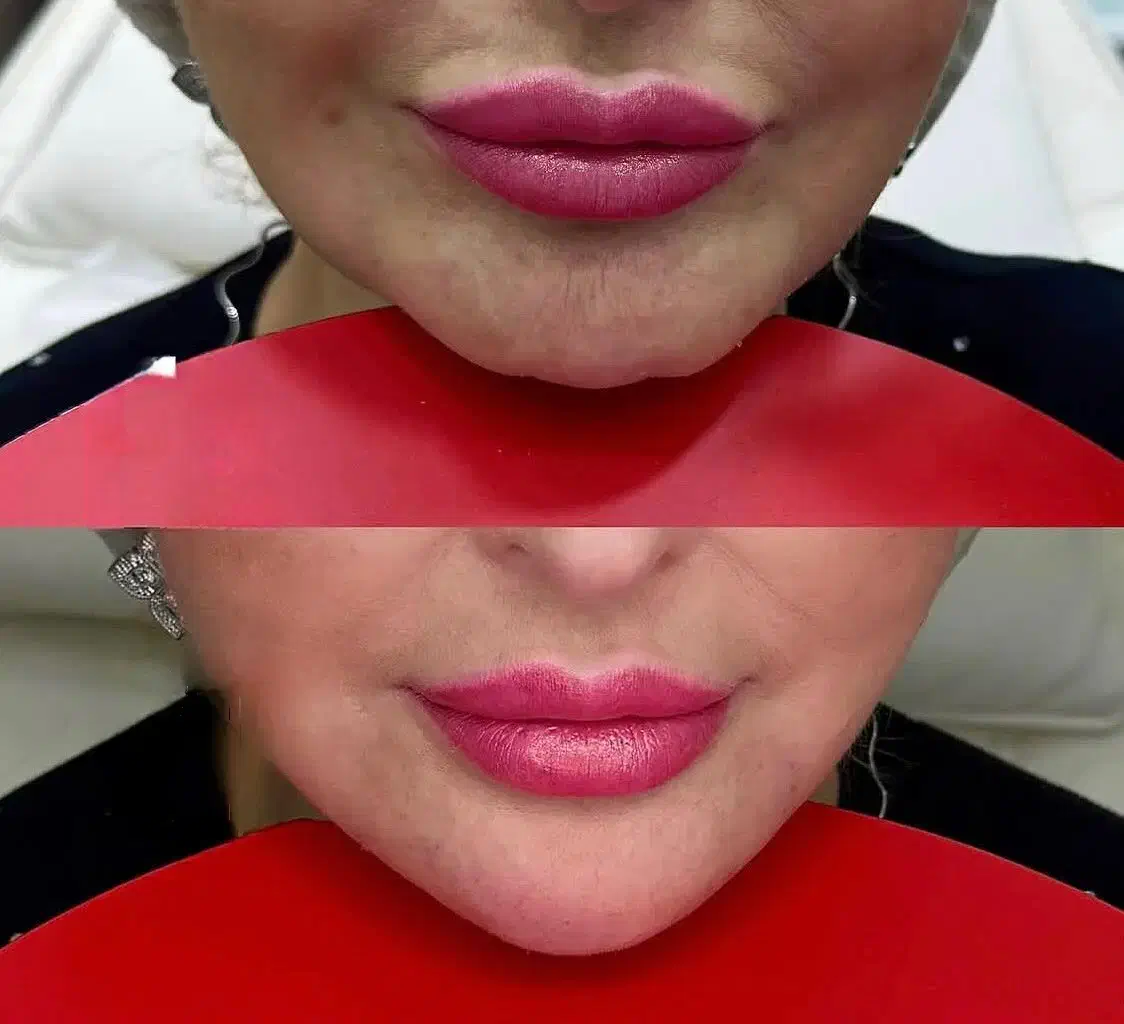 جذب مدل ژل صورت مخصوص فرمدهی و جوانسازی|خدمات آرایشگری و زیبایی|اندیمشک, |دیوار