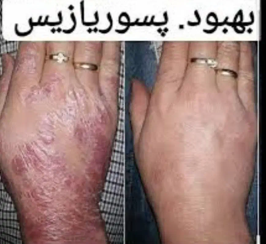 کرم درمان پسوریازیس و اگزما|آرایشی، بهداشتی، درمانی|تهران, حسین‌آباد|دیوار