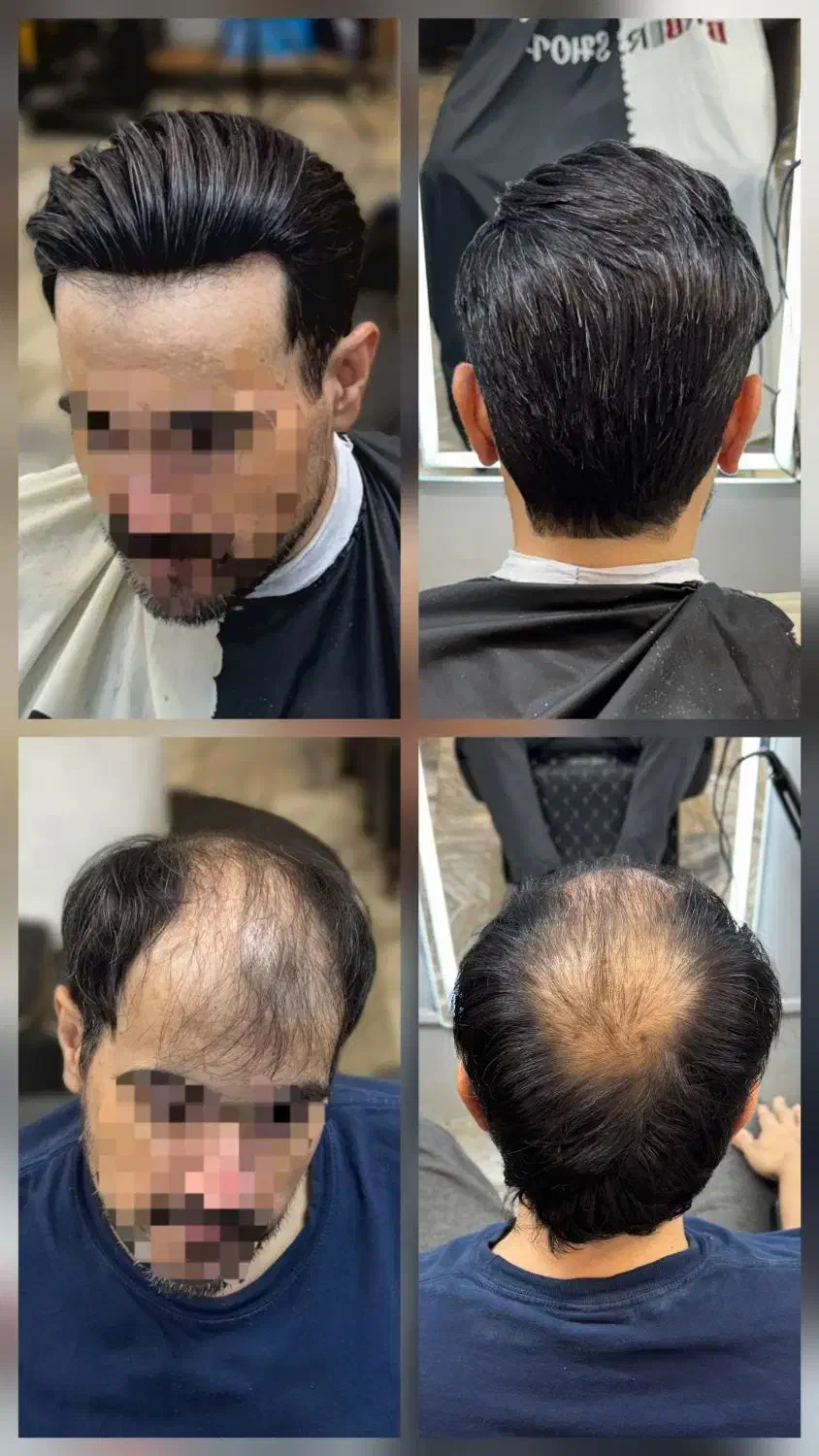 پروتز موی طبیعی و حرفه ای ویژه آقایان و بانوان|خدمات آرایشگری و زیبایی|کرمانشاه, |دیوار