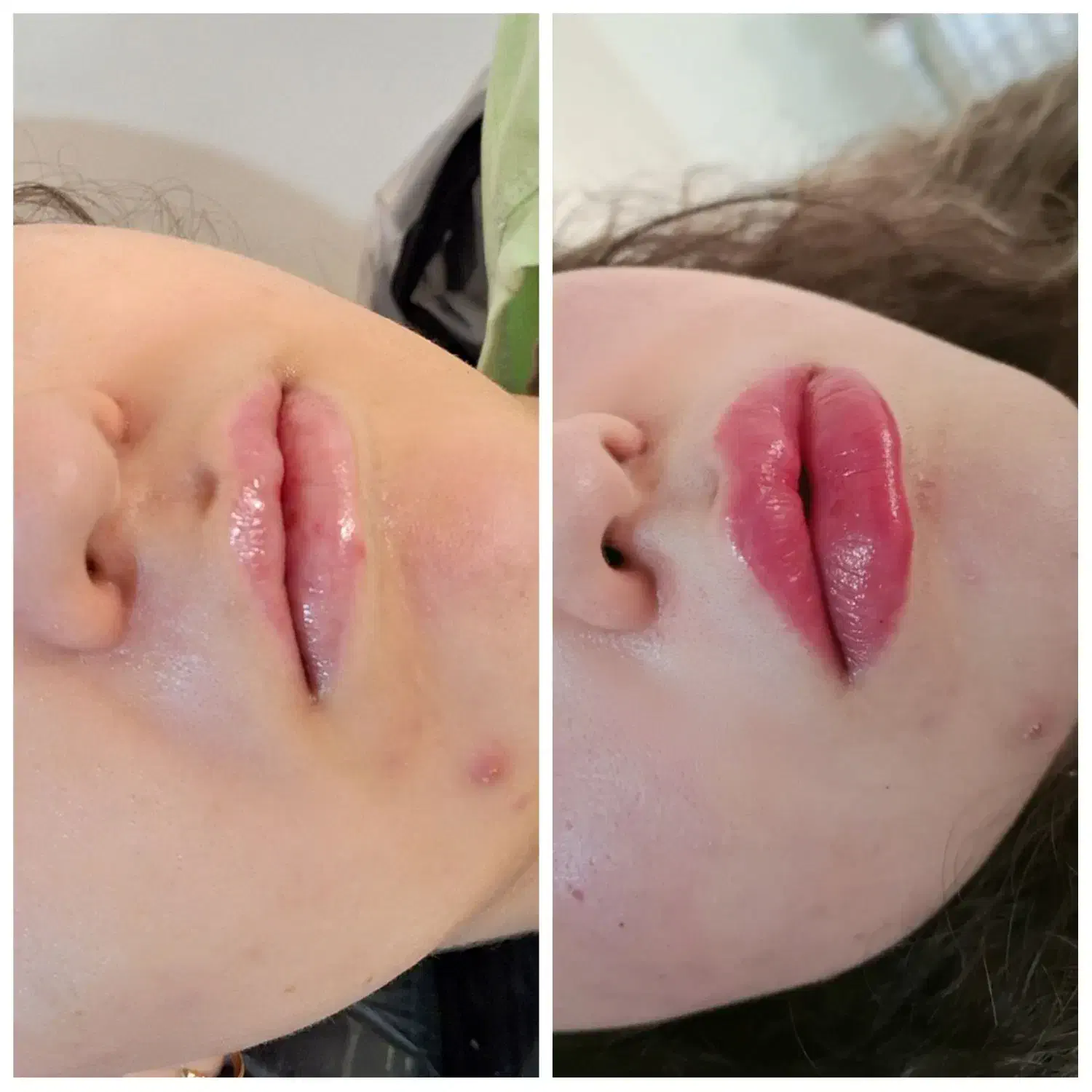 بوتاکس ژل نخ چالگونه مزو انزیم فیلر|خدمات آرایشگری و زیبایی|تبریز, |دیوار