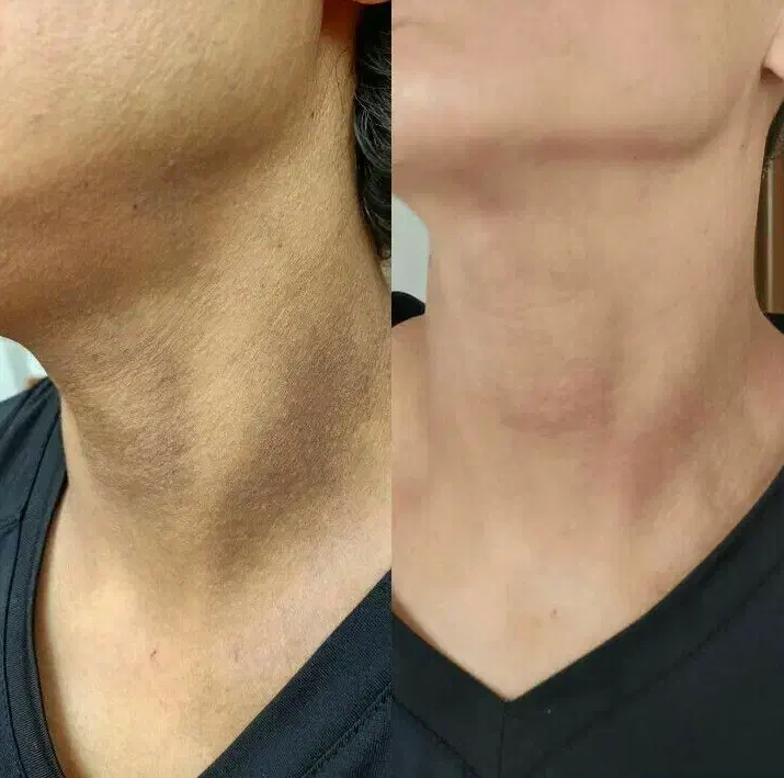 رفع تیرگی صورت وبدن فیشال تخصصی|خدمات آرایشگری و زیبایی|تهران, سلسبیل جنوبی|دیوار