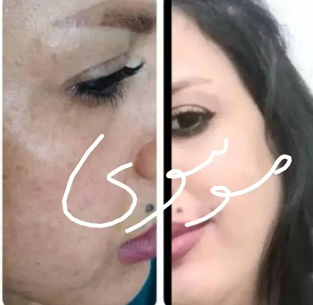 روشن کننده وضدلک درمانی صدرصد تضمینی بدون بازگشت|حراج|یاسوج, |دیوار