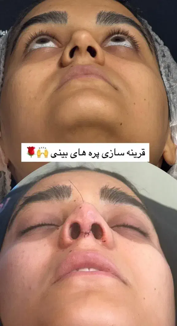 جشنواره ویژه جراحی بینی رینوپلاستی قیمت استثنایی|خدمات آرایشگری و زیبایی|جوانرود, |دیوار