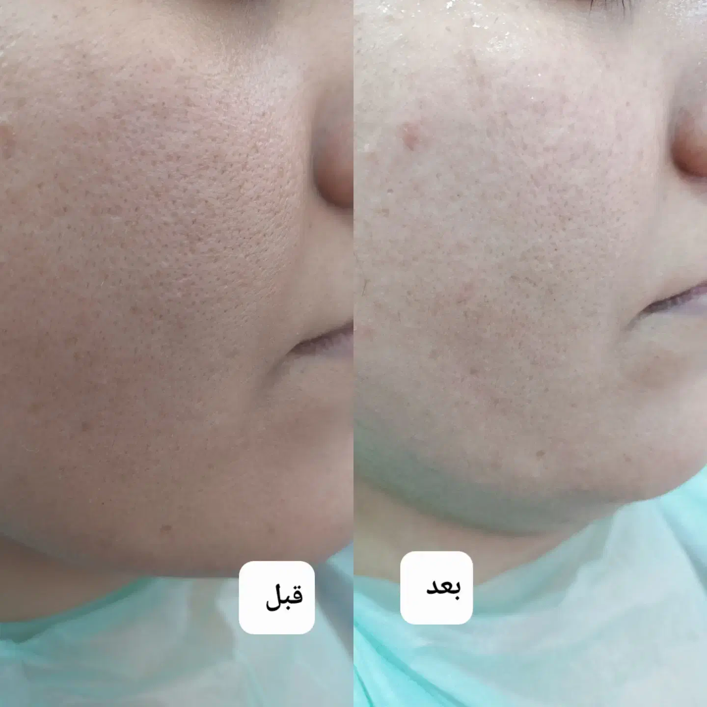 لک جوش و منافذ و جای جوش و لیفت و جوانسازی صورت|خدمات آرایشگری و زیبایی|زاهدان, |دیوار