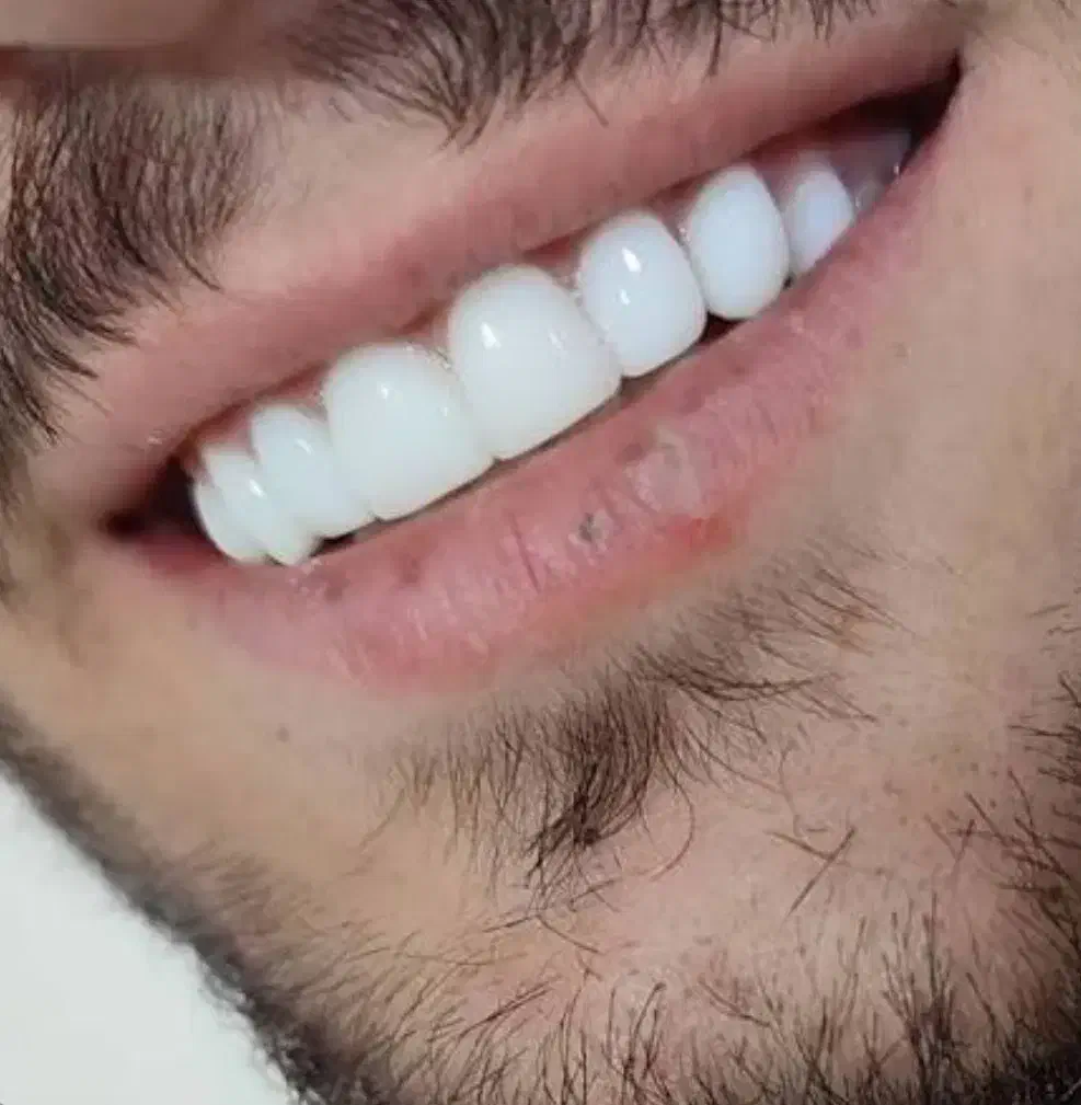 لمینت مترحک دندان اصل|آرایشی، بهداشتی، درمانی|ایلام, |دیوار