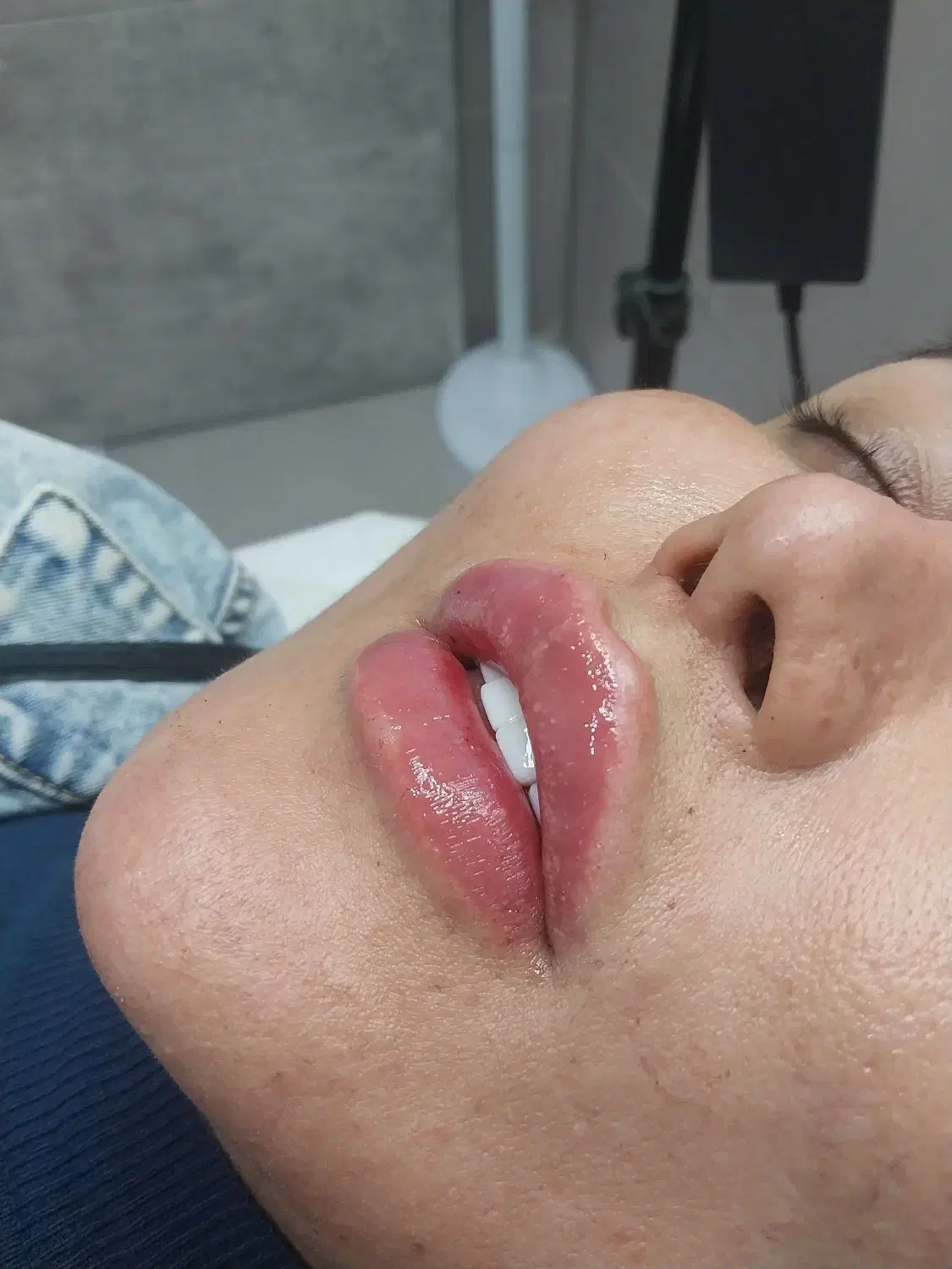 اموزش تزریقات زیبایی بوتاکس و فیلر و مزو|خدمات آموزشی|ارومیه, |دیوار