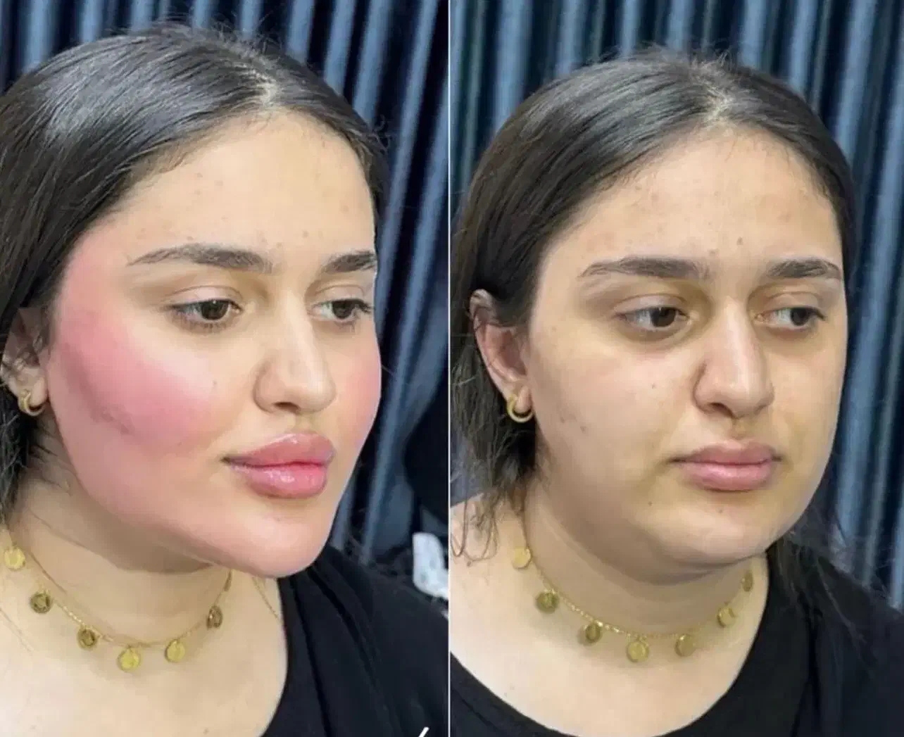 تخفیفات استثنایی ژل و بوتاکس در مطب زیبایی|خدمات آرایشگری و زیبایی|قم, دورشهر|دیوار
