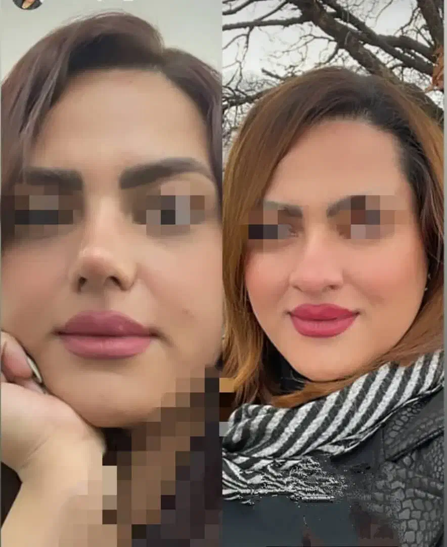 جشنواه ویژه  خدمات   عمل بینی لیپو ساکشن|خدمات آرایشگری و زیبایی|اهواز, کیانپارس |دیوار