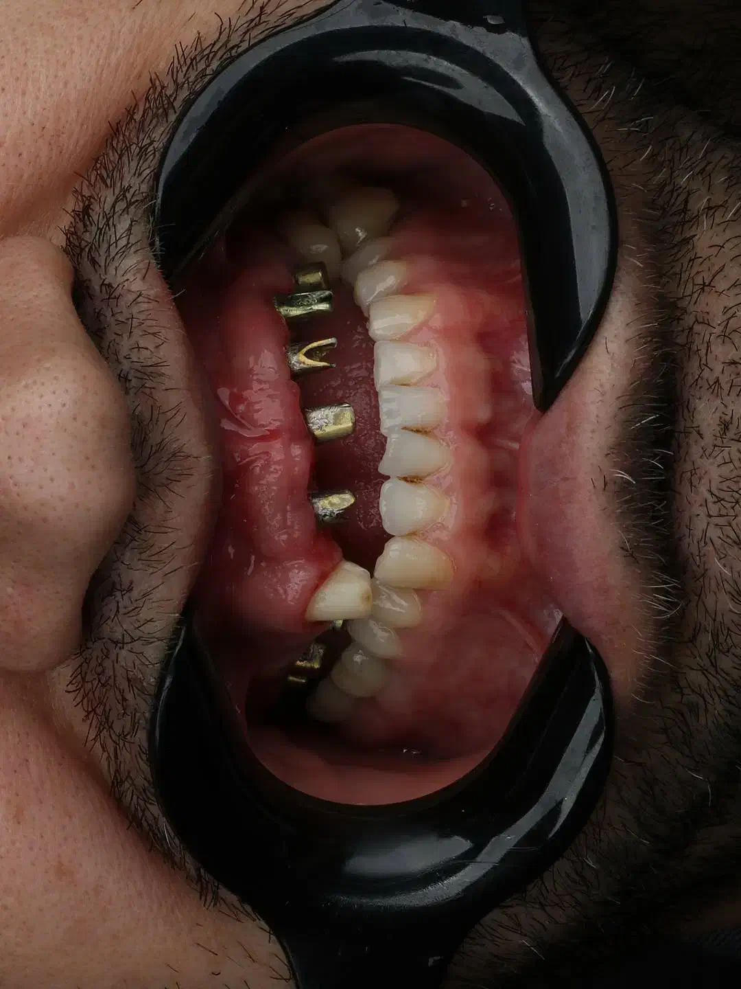 جشنواره کلیه خدمات دندانپزشکی با اقساط ۱۵ ماهه|خدمات آرایشگری و زیبایی|تبریز, |دیوار