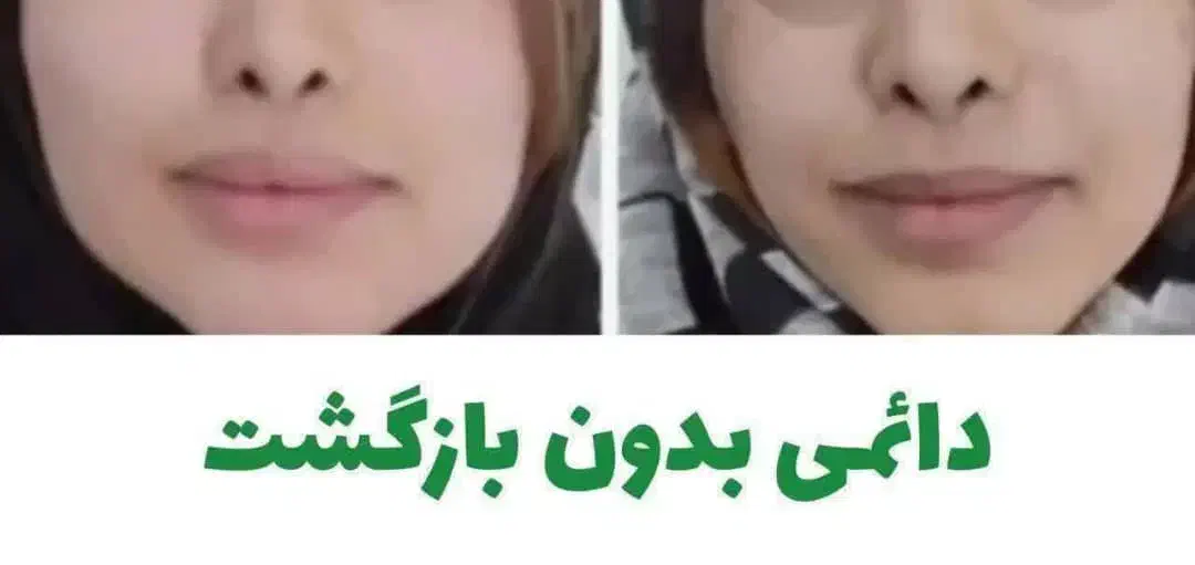 چاقی صورت به روش طبیعی|خوردنی و آشامیدنی|خاش, |دیوار