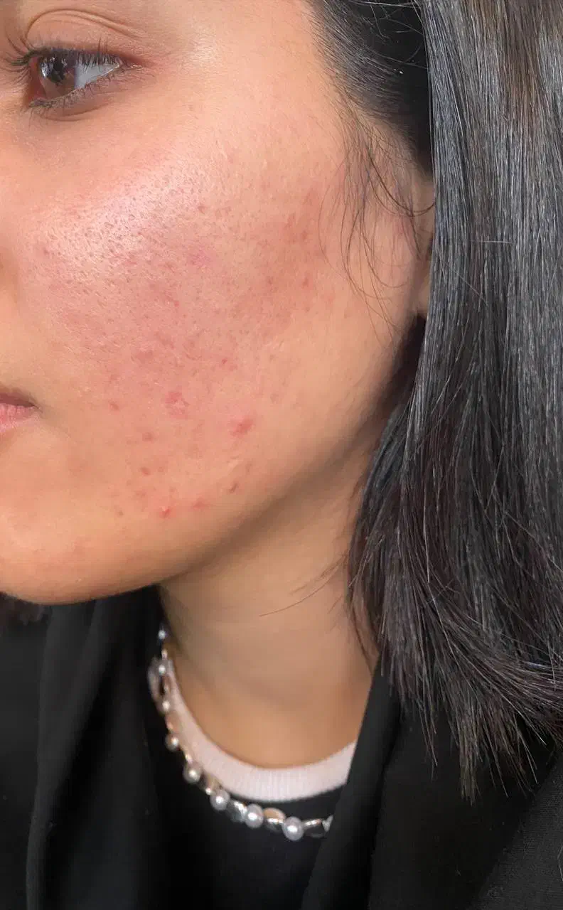 فیشیال و پاکسازی پوست|خدمات آرایشگری و زیبایی|ساری, |دیوار