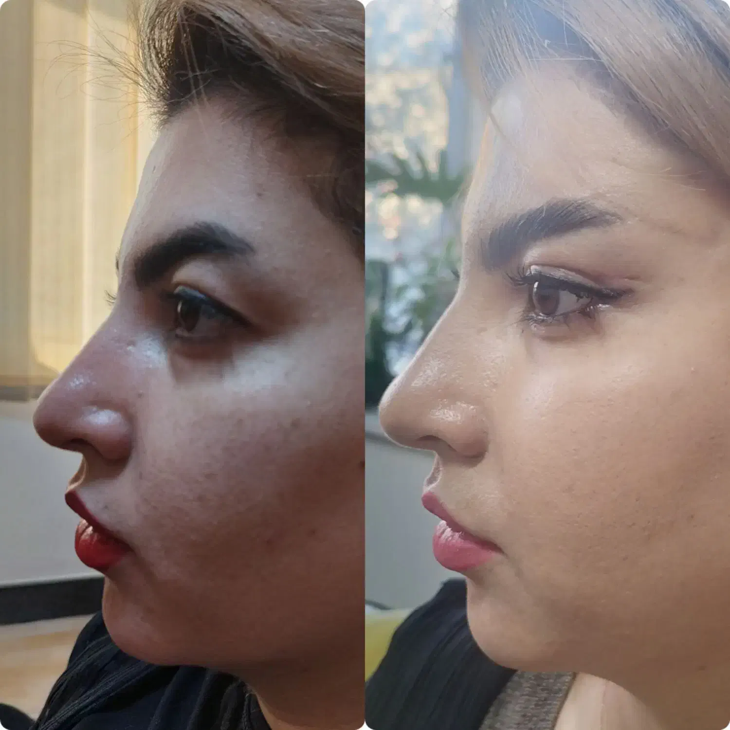 لیفت شقیقه وگونه با جراحی|خدمات آرایشگری و زیبایی|بوکان, |دیوار