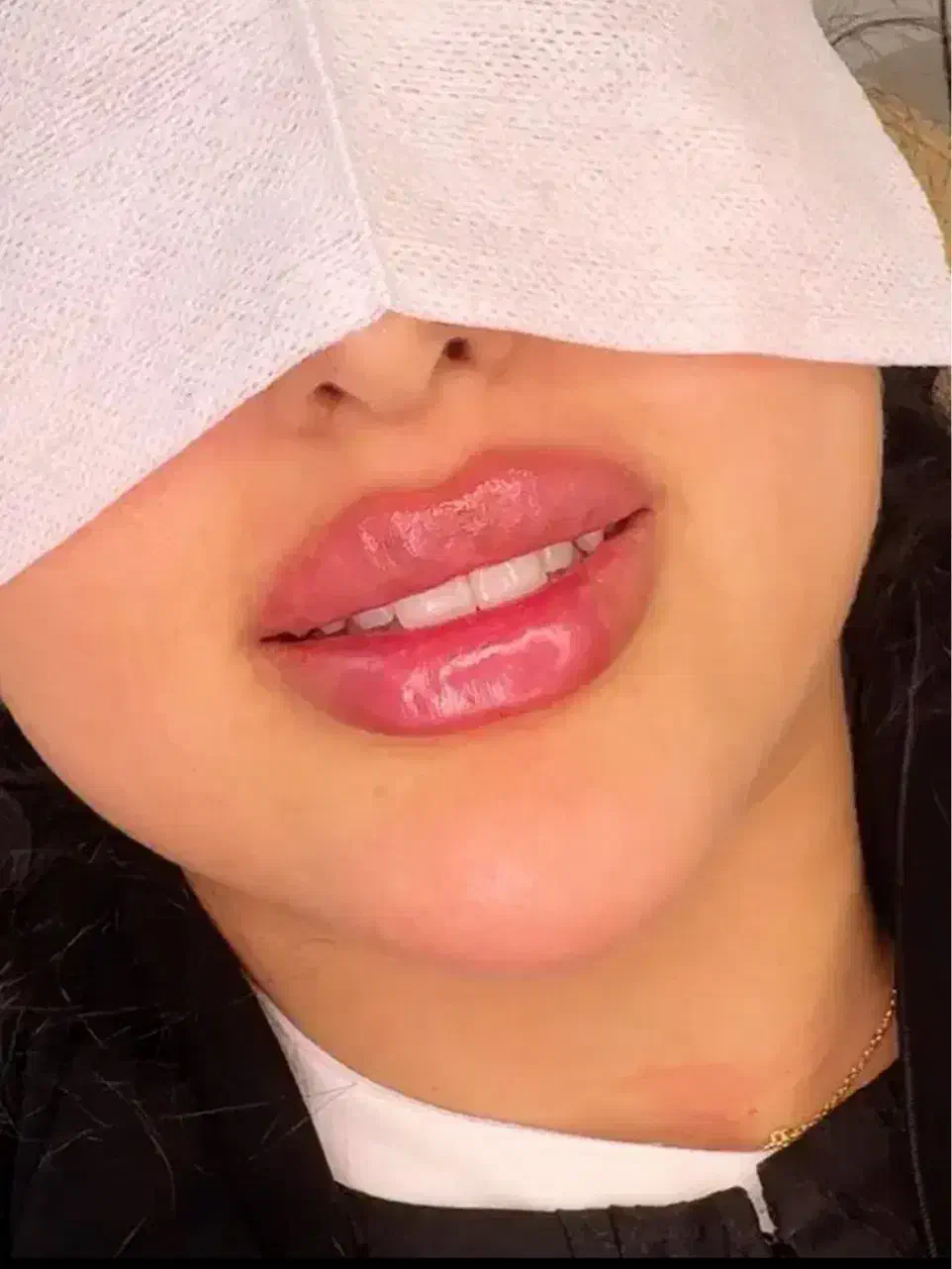 اف ژل لب وآف بوتاکس درمطب پزشک|خدمات آرایشگری و زیبایی|مشهد, احمدآباد|دیوار