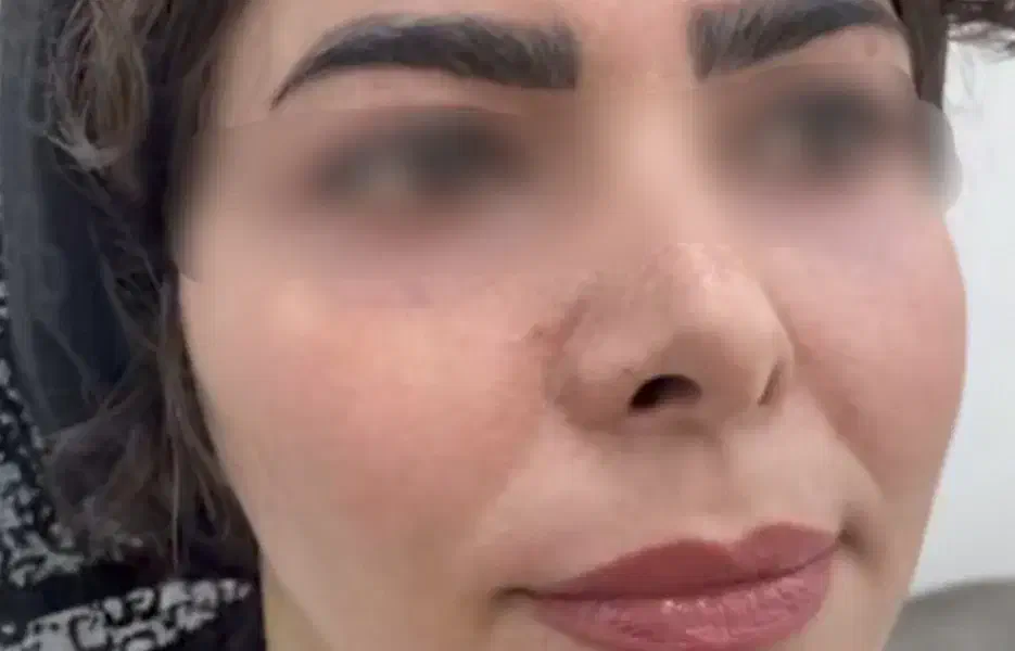 اماراتی ضدلک ترکیبی|آرایشی، بهداشتی، درمانی|خورموج, |دیوار