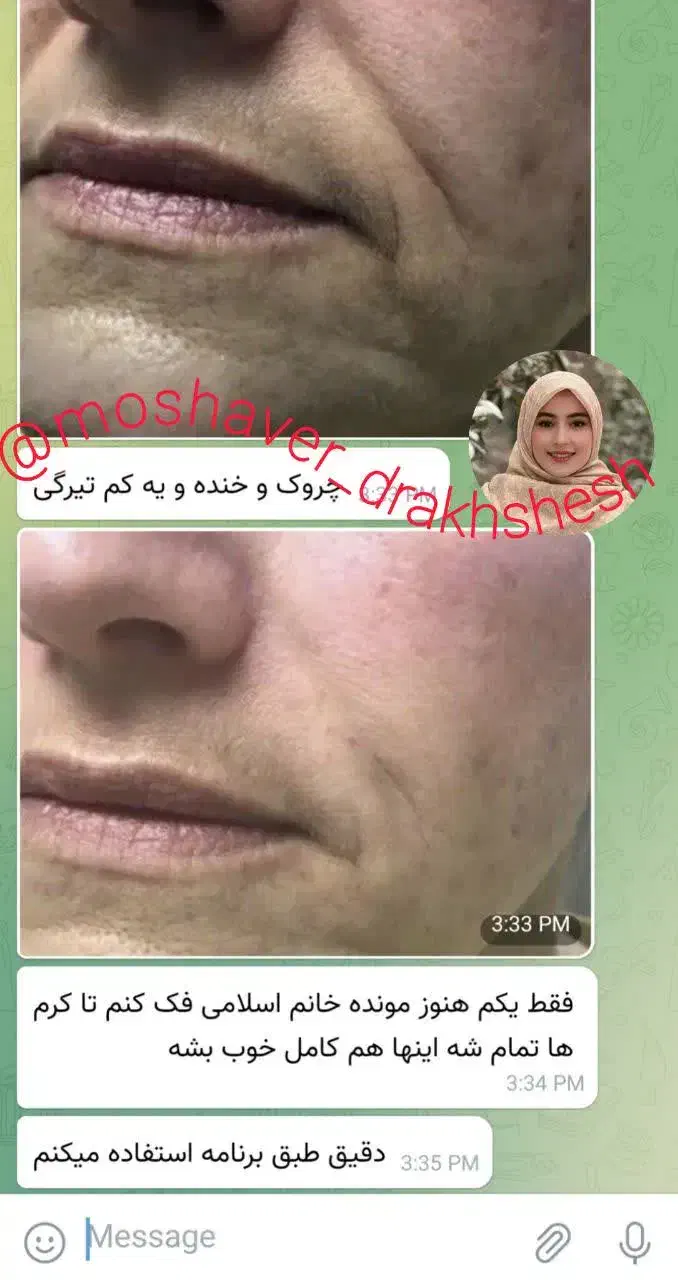 جوانسازی بیومیتیک بدون کار های تهاجمی|آرایشی، بهداشتی، درمانی|تهران, نگین غرب|دیوار