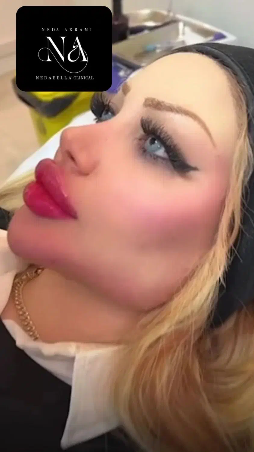 ژل لب و فول فیس ۳۷۰هزار تومان توسط پزشک کلینیک|خدمات آرایشگری و زیبایی|کرج, گوهردشت|دیوار