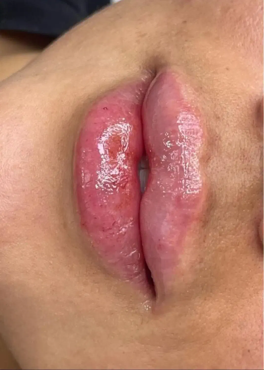 ژل وبوتاکس|خدمات آرایشگری و زیبایی|مشهد, ایثارگران|دیوار