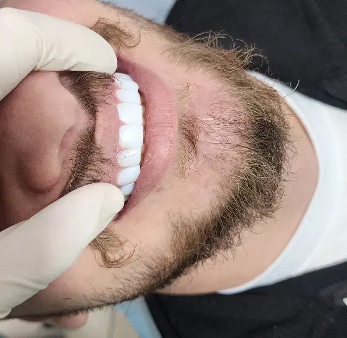 زیبایی،کامپوزیت دندان،عصب کشی(یاسوج)|خدمات آرایشگری و زیبایی|دوگنبدان, |دیوار