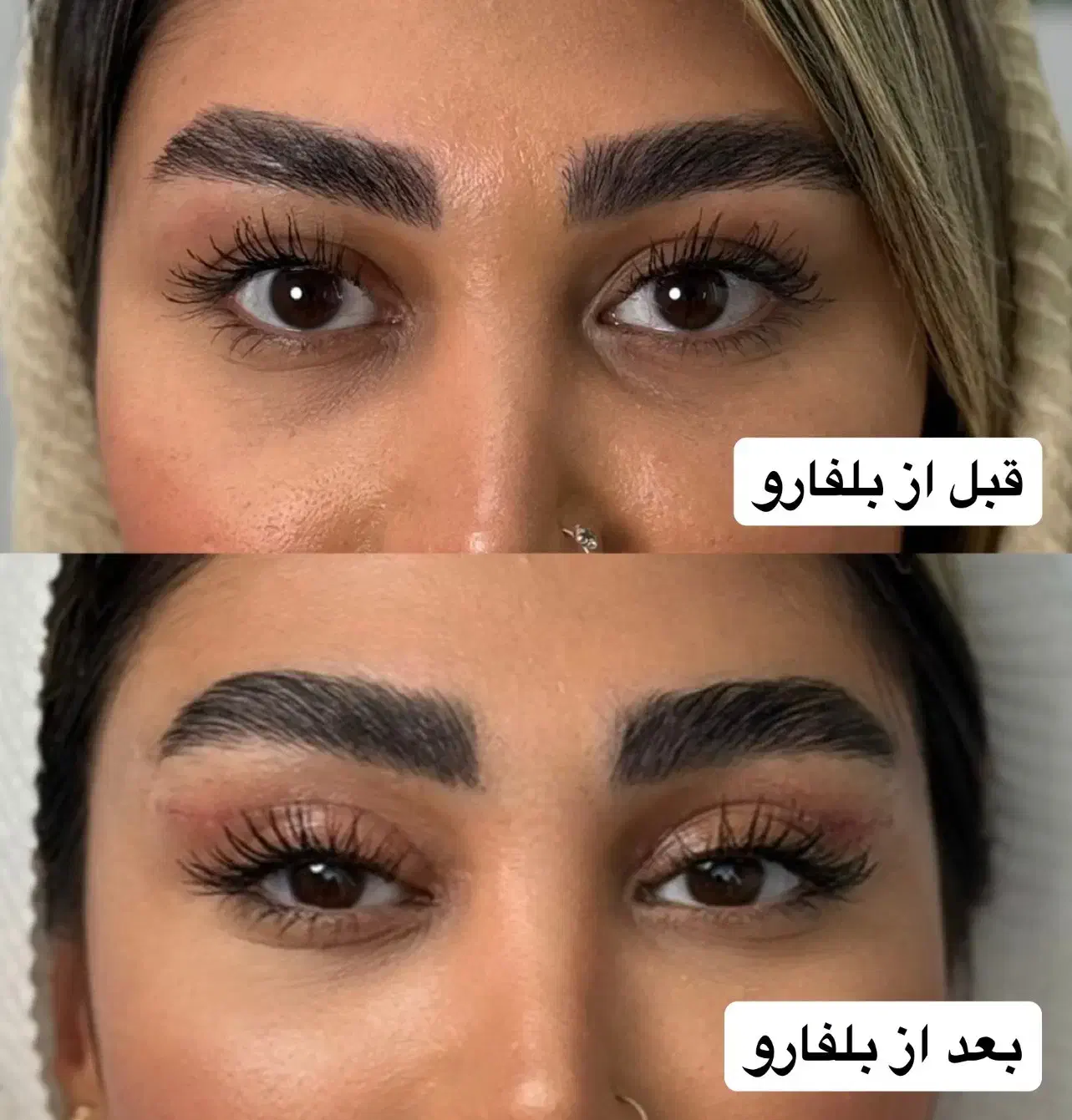 بلفارو روباهی در کلینیک مهرزاد|خدمات آرایشگری و زیبایی|تهران, جردن|دیوار