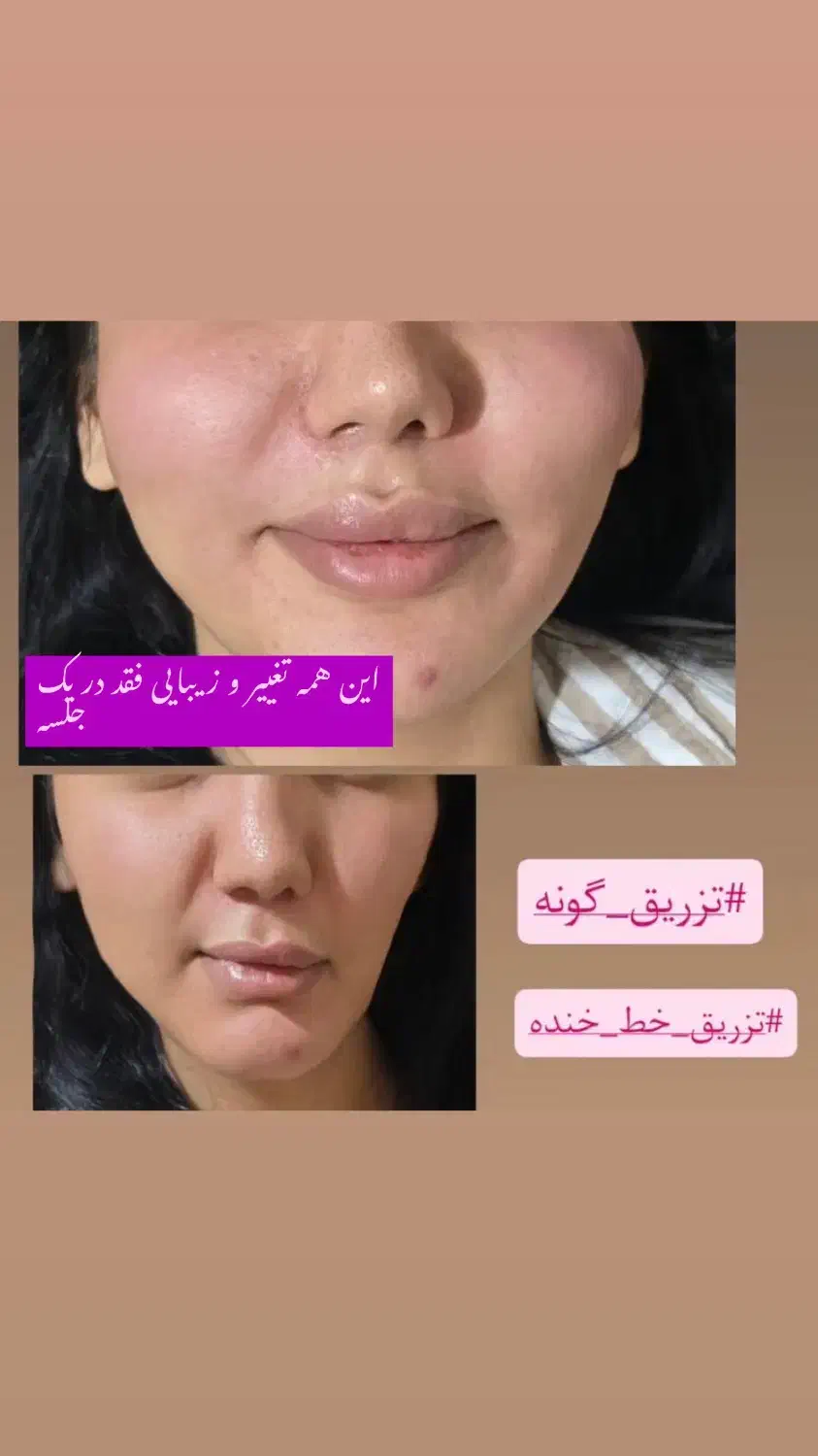 فیلر بادی ،تزریق ژل و بوتاکس با بهترین متریال قیمت|خدمات آرایشگری و زیبایی|دزفول, |دیوار