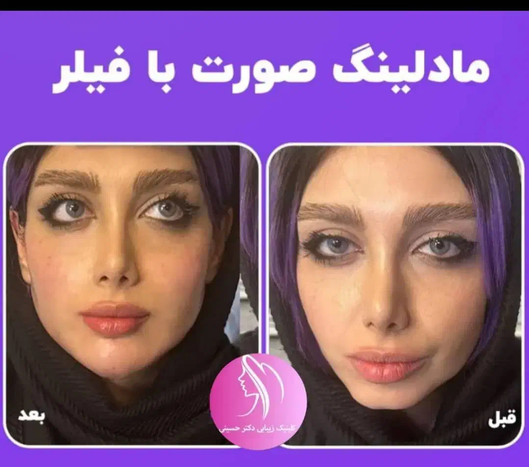 جشنواره لیزر مو تزریق ژل لب بوتاکس فیلر جوانساز|خدمات آرایشگری و زیبایی|تهران, صادقیه|دیوار