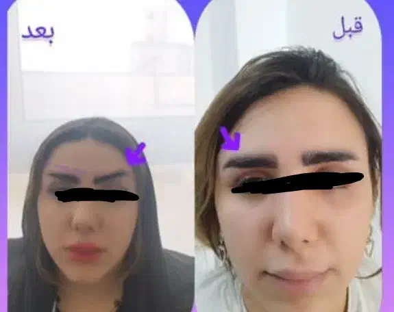 تزریق وتخلیه چربی جراحی پلک لابیا وغیره|خدمات آرایشگری و زیبایی|خرمآباد, |دیوار