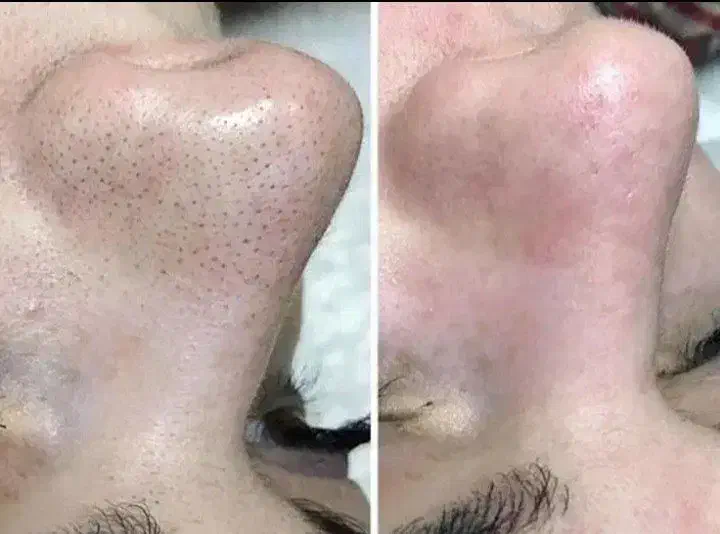 پاکسازی پوست تخصصی|خدمات آرایشگری و زیبایی|اسلامآباد غرب, |دیوار