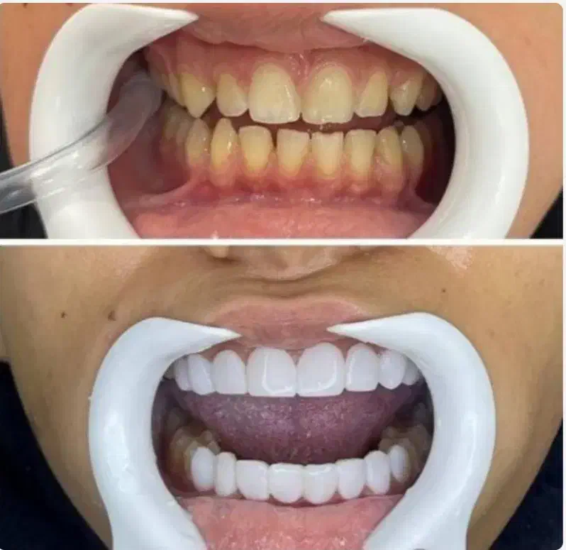 کامپوزیت دندان جشنواره ی تخفیفات تا شب یلدا|خدمات آرایشگری و زیبایی|رشت, معلم|دیوار