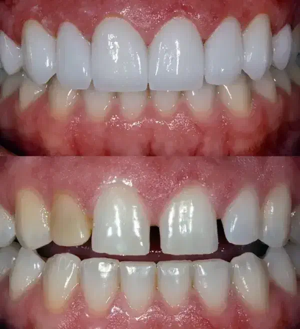 کامپوزیت زیبایی دندان(شهرستان بناب)|خدمات آرایشگری و زیبایی|میاندوآب, |دیوار