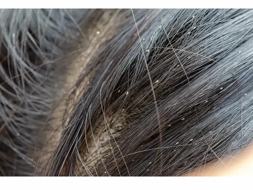 پاکسازی تخصصی شپش زیر نظر استاد حرفه ای|خدمات آرایشگری و زیبایی|قم, شاه ابراهیم|دیوار