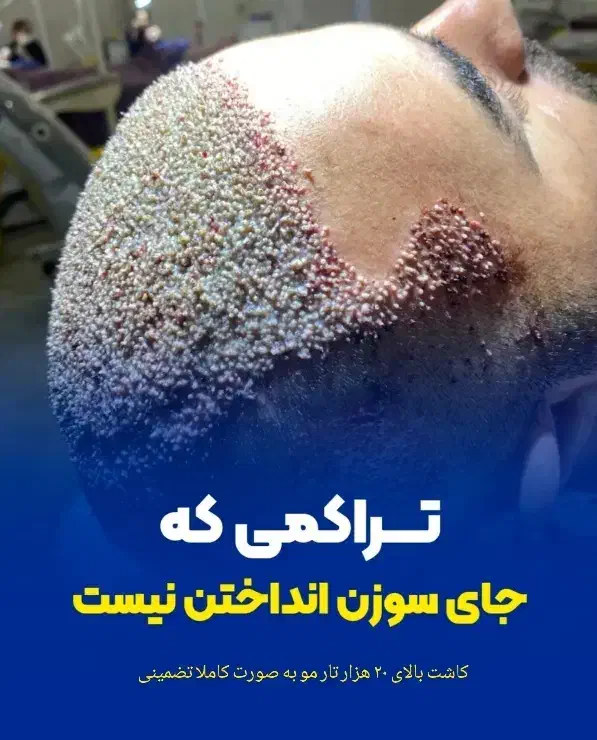 کاشت مو تارِنو|خدمات آرایشگری و زیبایی|خرم‌آباد, |دیوار