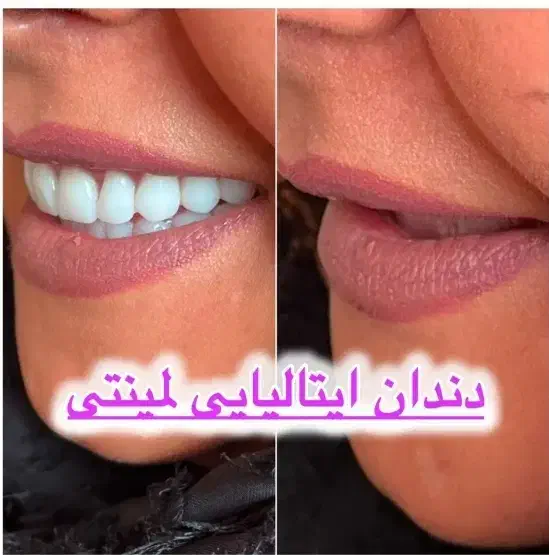 دندانسازی/دندان مصنوعی/جوان پسند/ چکی / تخفیف ویژه|خدمات آرایشگری و زیبایی|مشهد, عبادی|دیوار