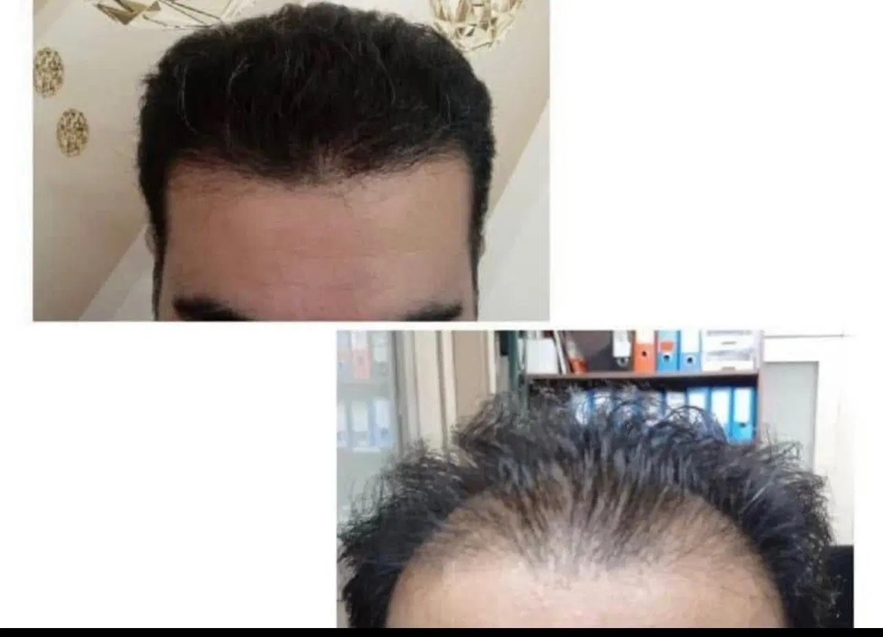 جشنواره کاشت مو فقط ۱۷ میلیون تومان|خدمات زیبایی و سلامت|تهران, ونک|دیوار