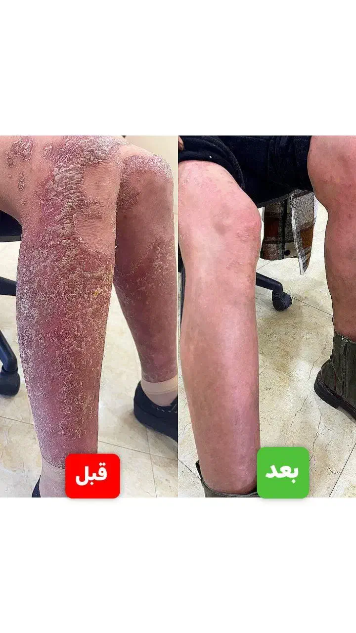 درمان بیماریهای پیسی وپسوریازیس واگزما  دائمی|خدمات آرایشگری و زیبایی|گرگان, |دیوار