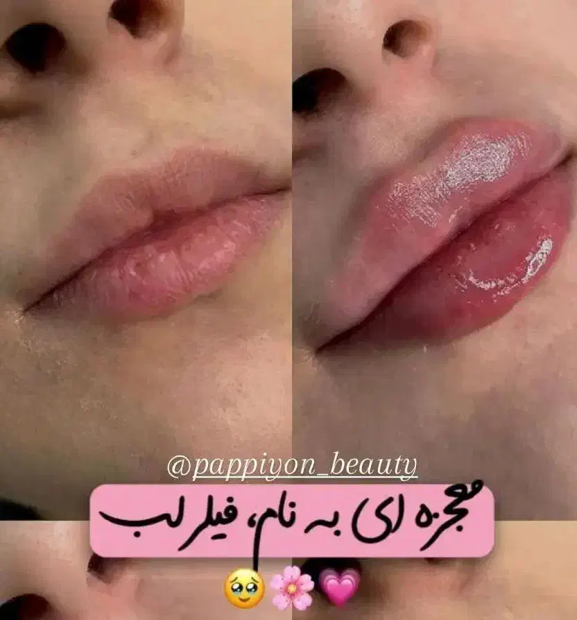 جشنواره کلینیک در کربنتراپی بوتاکس هایفو PRP|خدمات آرایشگری و زیبایی|اسلامشهر, زرافشان|دیوار