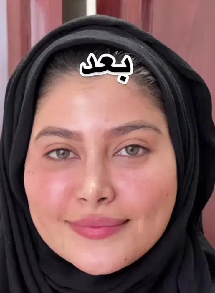 تزریق چربی ، تزریق ژل ، بوتاکس ، جراحی در مطب|خدمات آرایشگری و زیبایی|نورآباد, |دیوار