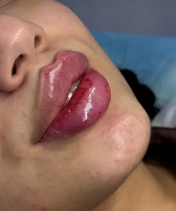 تزریق ژل فقط سیسی ۸۰۰بمدت سه روز|خدمات آرایشگری و زیبایی|زاهدان, |دیوار