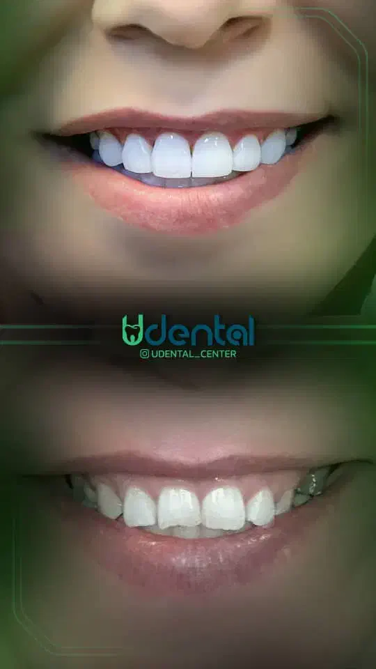 کامپوزیت، لمینت، ایمپلنت اقساط ویژه|خدمات آرایشگری و زیبایی|رشت, ساغری سازان|دیوار